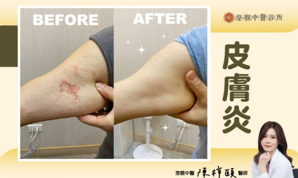 皮膚炎│皮膚專科│澄觀中醫 陳梓頤醫師