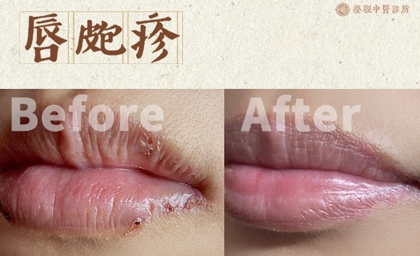 唇皰疹│皰疹病毒