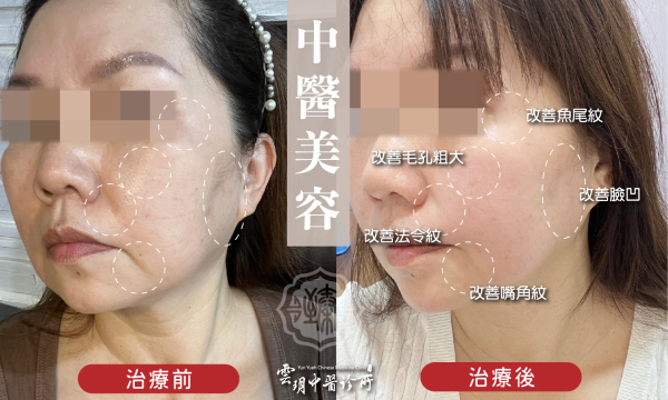 臉部不對稱│中醫美容