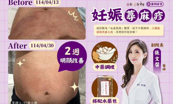 【妊娠蕁麻疹_小雅】案例分享｜澄觀(台北)副院長 張文馨 醫師