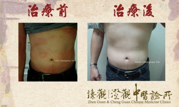 【蕁麻疹】澄觀(台北) 院長 蕭善文醫師