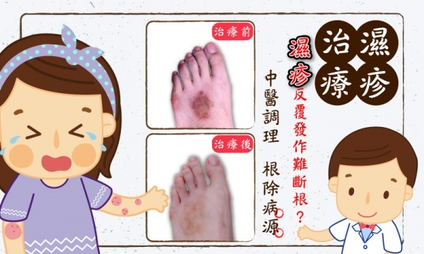 【濕疹】臻觀中醫體系 總院長 陳建輝醫師