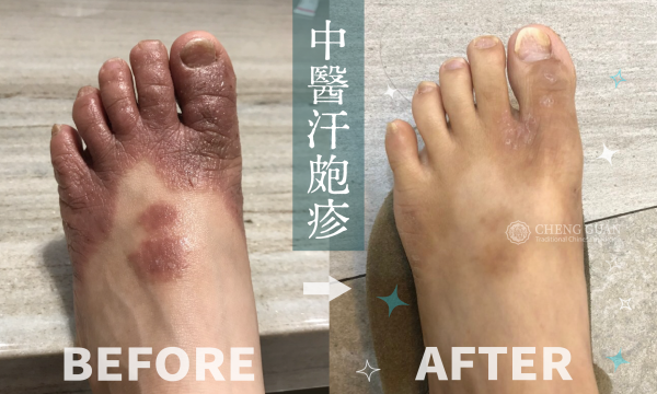 汗皰疹│中醫皮膚專科 鄭芸庭醫師