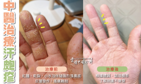 汗皰疹│澄觀中醫精誠院