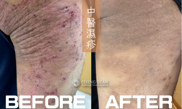 濕疹│中醫皮膚專科 澄觀中醫 鄭芸庭醫師