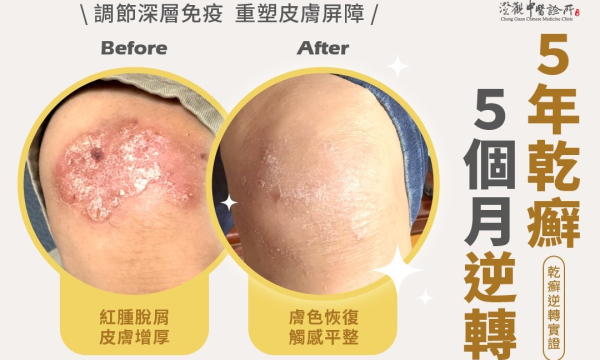 5 年乾癬，5 個月逆轉｜澄觀中醫 吳宛玟醫師