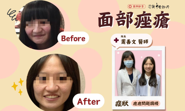 【面部痤瘡_袁小姐】案例分享｜ 澄觀(台北)院長 蕭善文 醫師