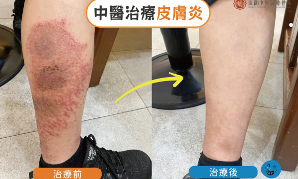 皮膚炎│ 中醫皮膚專科
